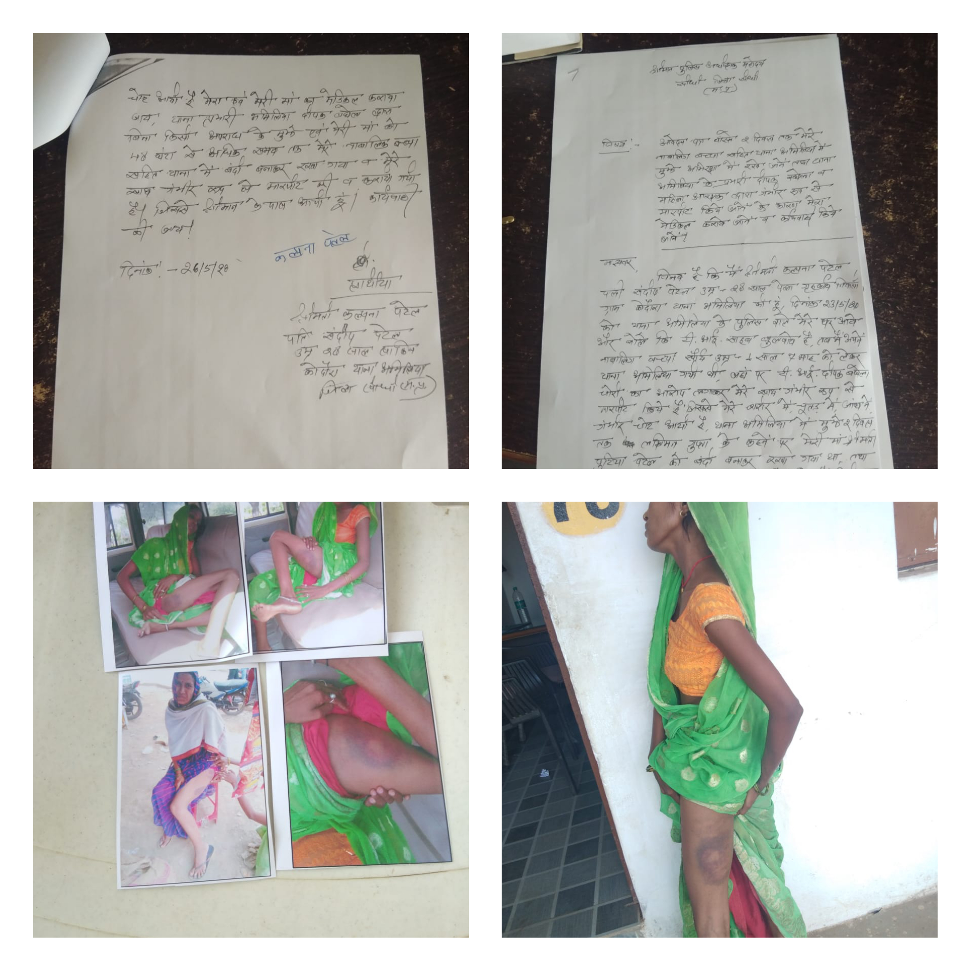 अमिलिया थाना प्रभारी ने दो महिलाओं को बेरहमी से पीटा  उपचार हेतु दिए दो हजार , संदिग्ध चोरी के आरोप में किया था गिरफ्तार  पीड़िता ने एसपी से लगाई न्याय की गुहार 